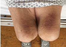 Figure 1. Hyperpigmented, thickened skin on both thighs.