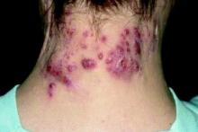 hidradenitis suppurativa on the neck