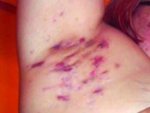 Hidradenitis suppurativa lesions under the arm