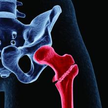 Intertrochanteric hip fracture