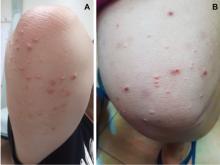 Figure 1. The patient had multiple pink to yellowish papules 2 to 5 mm in diameter over the extensor surface of the right upper arm (A) and left thigh (B).