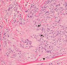 Figure 2. Biopsy study showed foamy histiocytes (arrows) mixed with streaks of connective tissue (arrowhead) in the dermis, features typical of eruptive xanthoma (hematoxylin and eosin, × 200).