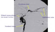 FIGURE 2. Cerebral angiogram showing the vertebral AVF as a dilated venous plexus as well as an engorged cavernous sinus and ophthalmic veins