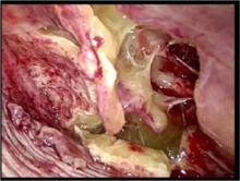 Figure 3. Tenacious exudate in the intrapleural space at the time of VATS in a child with empyema.