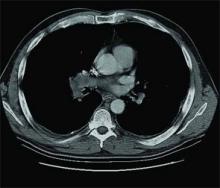 en CT-scanning af patientens bryst.'s chest.