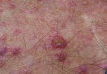 A cutaneous eruption plagues the patient