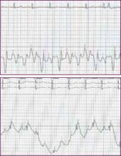 Abbildung 1. RA = rechtsatriale Drücke, PCWP = pulmonaler kapillarer Keildruck