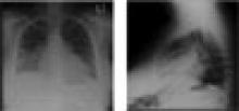 Ryc. 2. Posteroanterior and lateral chest X-rays showing basilar infiltrates and an enlarged cardiac silhouette