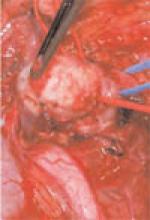 Figure 2. Intraoperative photograph of renal artery aneurysm.