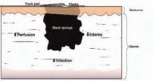 Figure 3: The mechanism of VAC therapy: improvement of tissue perfusion, reduction of bacterial load and edema.