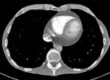 Figure 2: Pericardial effusion