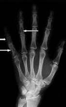 Figure 1: Multiple lucent lesions