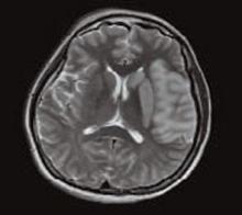 Figure 3. MRI of Left-Sided Cerebrovascular Accident