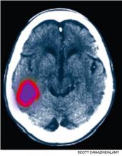CT scan of a human brain showing posterior temporal stroke.