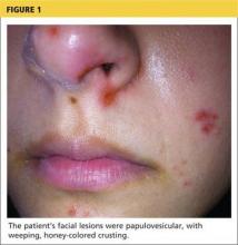 Woman, 32, With Crusty Red Blisters | Clinician Reviews