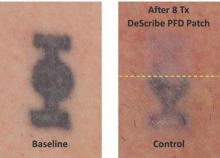 Tattoo removal results after eight laser treatments through a perfluorodecalin-infused patch (top) and without a patch (bottom).