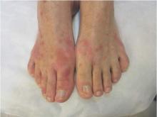 Blanchable macules and papules, seen here on the feet, tend to start on the face or trunk, 3-5 days after the febrile phase, and become more diffuse. 