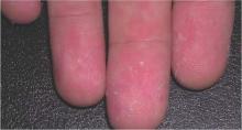 Similar blanchable macules and papules are seen here on the fingers.