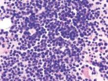 Histopathological image of multiple myoloma. Bone marrow aspirates. Hematoxylin & esoin stain.