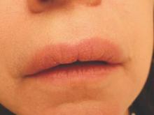 Figure 1. Upper lip swelling without ulceration, fissuring, or scaling. The lower lip was completely spared.