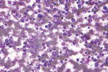 This is a micrograph of a diffuse large B cell lymphoma.