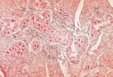 Histopathology of cytomegalovirus infection of salivary gland.