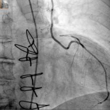 High LIMA graft patency seems promising for long-term survival after HCR.