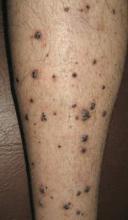 Figure 1. Multiple black keratotic papules on the right lower leg. 