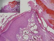 Figure 3. Histologic examination revealed dilated, blood-filled vessels in the papillary dermis with overlying acanthosis and hyperkeratosis consistent with an angiokeratoma (H&E, original magnification ×10 [inset ×4]).