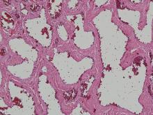 Figure 4. Histologic examination revealed a multilobular proliferation of numerous vascular spaces in the dermis demonstrating lobular and cavernous hemangiomas (H&E, original magnification ×10).