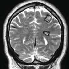 Figure 5. T2-weighted coronal magnetic resonance imaging study showing areas of heterogeneous signal intensity with T2 hypointense rims consistent with cerebral cavernous malformations. 