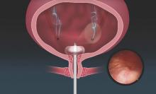 A pancake-shaped balloon keeps the Cystosure scope tip low in the bladder to ensure easy and safe visualization of the ureteral openings.