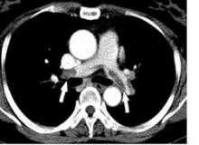 Pulmonary embolism is shown here.