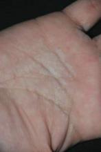 Figure 5. White cobblestonelike papules located around the palmar flexures in a 25-year-old woman. 