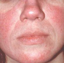 Flushing and persistent redness characterize erythematotelangietatic rosacea. 