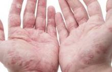 psoriasis on the hands of an adult male