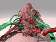 A virus infects the tumor and delivers an enzyme, which activates a chemotherapeutic prodrug.