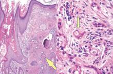 Figure 1. Dermal infiltrate with tadpole morphology (arrow) characteristic of syringoid eccrine carcinoma (left)(H&E, original magnification ×40). High-power view shows an epithelial infiltrate and tadpole morphology (arrow)(right)(H&E, original magnification ×400). 