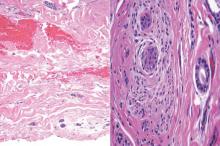 Figure 2. Syringoid eccrine carcinoma extending to the junction of the reticular dermis and subcutaneous fat (left) (H&E, original magnification ×100). Nerve with adjacent and invasive basaloid nests of syringoid carcinoma (right)(H&E, original magnification ×100). The tumor consists of monomorphic cells with oval hyperchromatic nuclei. 