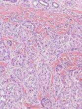 Figure 4. Metastatic adenocarcinoma of the skin with dermal infiltrating glands (H&E, original magnification ×100). The nuclei are highly atypical. The tumor cells are cytokeratin 7 positive, cytokeratin 20 negative, estrogen-receptor positive, and gross cystic disease fluid protein positive, which is consistent with metastasis from a primary carcinoma of the breast (not shown).