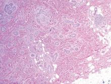 Figure 5. Deeply invasive tumor with multiple architectures (sclerosing and micronodular) in a case of sclerosing basal cell carcinoma (H&E, original magnifi-cation ×40). Basaloid nests without true lumen formation invade subcutaneous adipose tissue. 