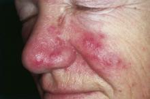 Inflammatory papules and pustules are observed over the nose in an individual with rosacea.