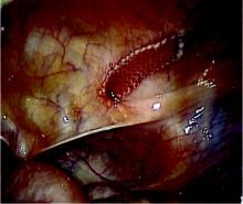 Laparoscopy weeks after TVT placement. Intraperitoneal segment of mesh showing needle entry during placement; bowel injury was narrowly avoided in this case.