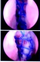 Urethroscopy following another physician's attempt at sling loosening with a urethral dilator and downward traction. The urethra gave way before the sling did.