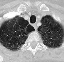 A CT scan shows air space destruction – a hallmark of emphysema – in the lungs of a patient carrying an NAF1 mutation.