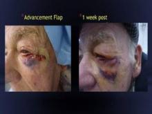 This patient is 1 week postop after an advancement flap.