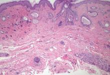 Predominately superficial lesion composed of dilated ducts in fibrotic stroma (H&E, original magnification _40). Careful microscopic exam would reveal no perineural or deep subcutaneous tumor involvement.