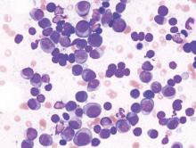 Histopathological image of multiple myeloma. Smear preparation of bone marrow aspirate stained with May-Grünwald-Giemsa procedure.