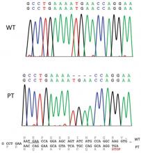 Sequencing analysis of the fumarate hydratase gene. DNA chromatograms: top, wild-type (WT) control; middle, patient (PT); bottom, comparison of WT and mutant DNA and protein sequences. Each gene located on autosomes has 2 copies, both of which are amplified during DNA sequencing. The height of peaks in the chromatograms represents the sum of nucleotides from both the copies. In this case (PT), there is a heterozygous c.1083_1086delTGAA 4-base pair deletion (TGAA deleted at positions 1083 through 1086 [complementary DNA]) in one copy and therefore the respective peak heights are reduced by approximately half compared to the WT. This deletion (underlined in bottom panel) leads to a frameshift in the coding sequence, resulting in altered amino acid sequence and a premature stop codon 10 codons downstream of the deletion, and thus a truncated protein.