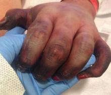 Figure 2. Cutaneous signs of iatrogenic, vasopressor-induced ischemia; gangrene of the distal digits of the left hand; and pronounced demarcation of vessels, as well as a vascular indication of thrombosis and lack of blood flow to the affected areas.  Figure 2. Cutaneous signs of iatrogenic, vasopressor-induced ischemia; gangrene of the distal digits of the left hand; and pronounced demarcation of vessels, as well as a vascular indication of thrombosis and lack of blood flow to the affected areas.